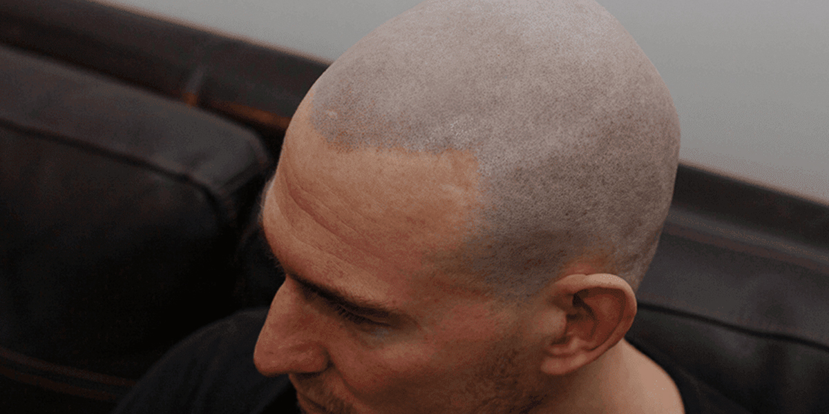 From Bald to Bold - Discovering Scalp Micro Pigmentation in Dallas
